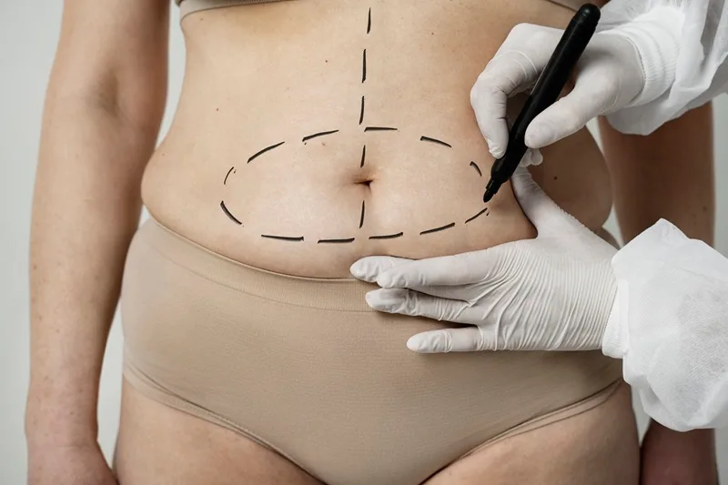Minilipectomía en CDMX